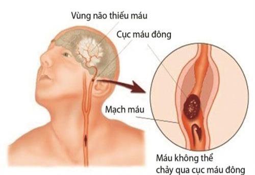 Vì sao cần theo dõi rối loạn đông máu ở người nhiễm COVID-19?