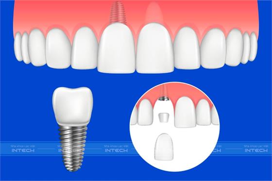 Trồng răng cửa giá bao nhiêu? Nên lựa chọn phương pháp nào?