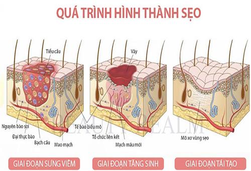 Nguyên nhân gây sẹo lồi và cách trị sẹo lồi hiệu quả hiện nay