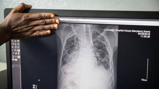  Virus lao Mycobacterium gây bệnh lao, chủ yếu ảnh hưởng đến phổi của người. Ảnh: Getty Images